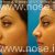 الأنف جراحة التجميل، للدكتور محسن نراقی