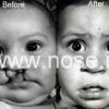 cleft_lip_repair