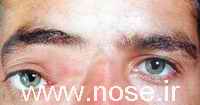 1 Frontal Mucocele