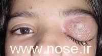 2 Periorbital Abscess