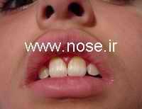 nose6