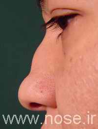 3 Saddle Nose