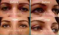 blepharoplasty