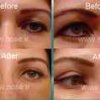 blepharoplasty