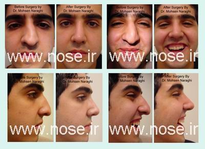 nose_surgery