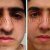 Nose Plastic Surgery by Dr. Mohsen Naraghi