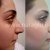 Nose Plastic Surgery by Dr. Mohsen Naraghi