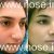 Nose Plastic Surgery by Dr. Mohsen Naraghi