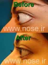 endonasal_decompression
