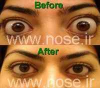 endoscopic_orbital_decompression