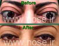 endoscopicorbitaldecompression1_20070923_1301964569