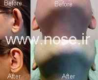 otoplasty