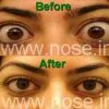endoscopic_orbital_decompression