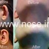 otoplasty