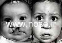 cleft_lip_repair