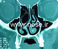 nose1
