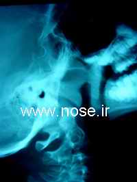 adenoid4