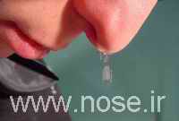 CSF Rhinorrhea