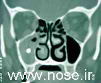 1 Fungus Ball Sinusitis